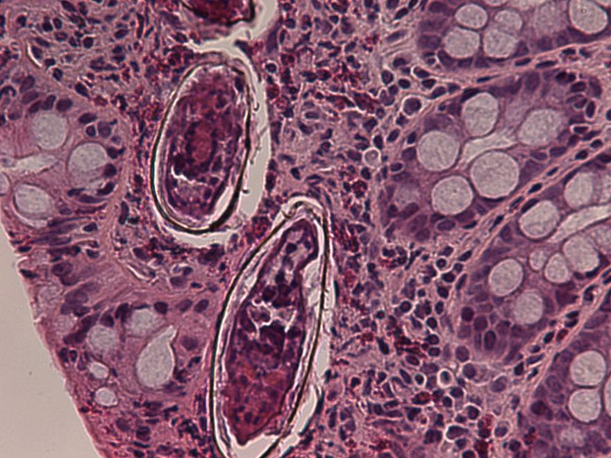 schistosomiasis gallbladder