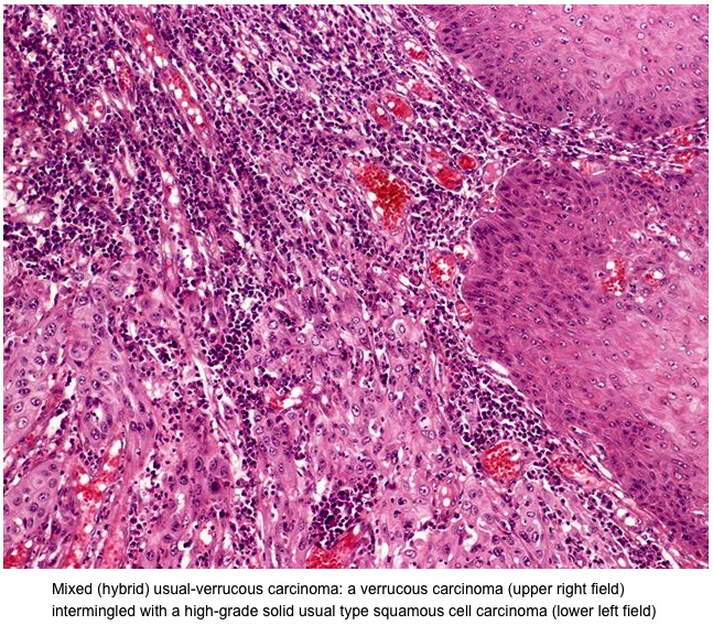 Malignant Transformation Of Proliferative Verrucous Leukoplakia To Oral Squamous Cell Carcinoma