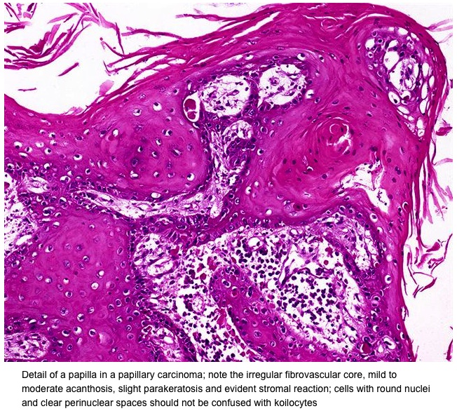 Pathology Outlines Papillary Carcinoma.