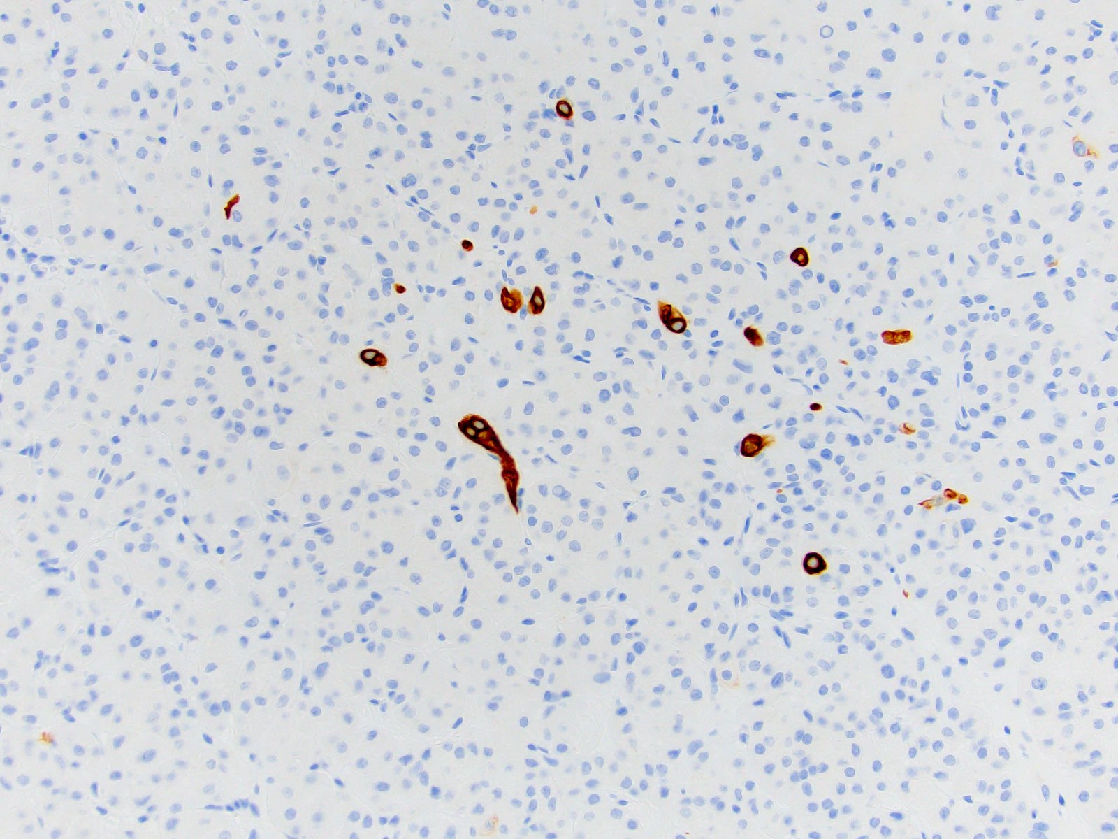 mesothelioma in nurse