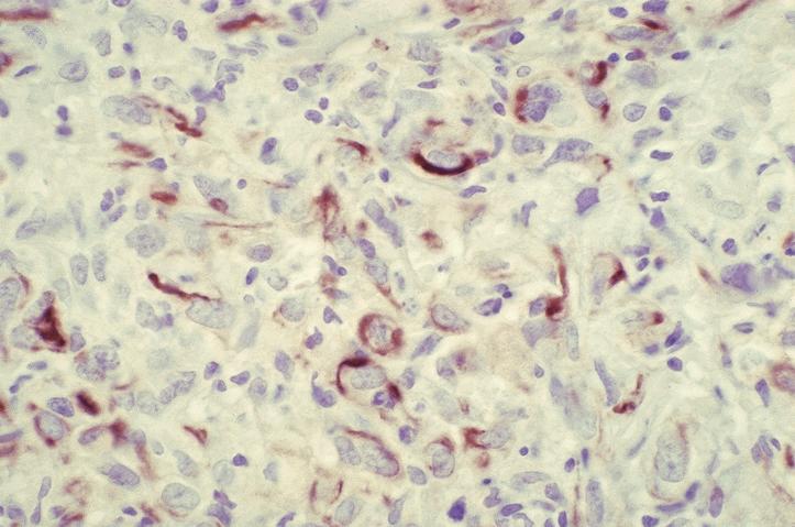 Keratin stains many mesenchymal-like tumor cells