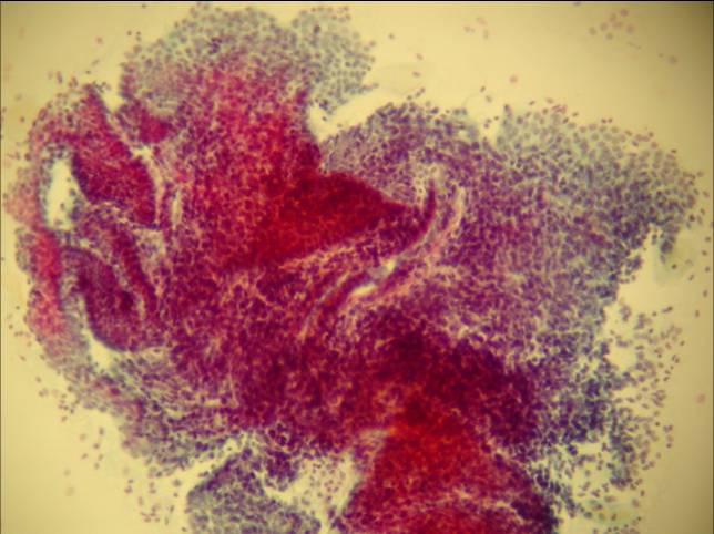 FNA from abdominal wall