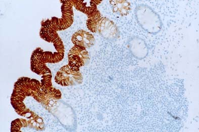 Mi a húgyhólyag epitéliuma? - Prosztatagyulladás - , Fordított papilloma hólyag ck20