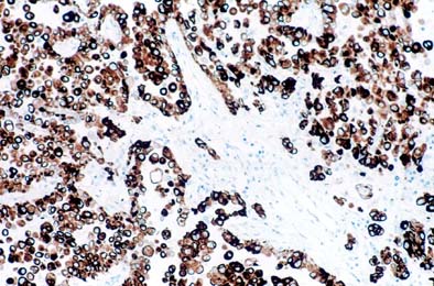 Pathology Outlines Cytokeratin 5 6 And Ck5