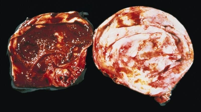 Cyst contains chocolate colored fluid