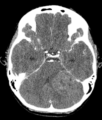 CT scan with contrast