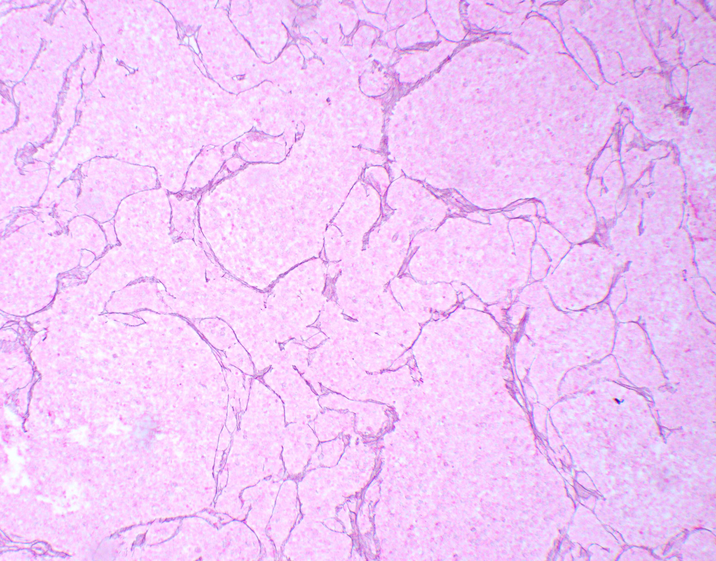 Vague nodular formation with reticulin