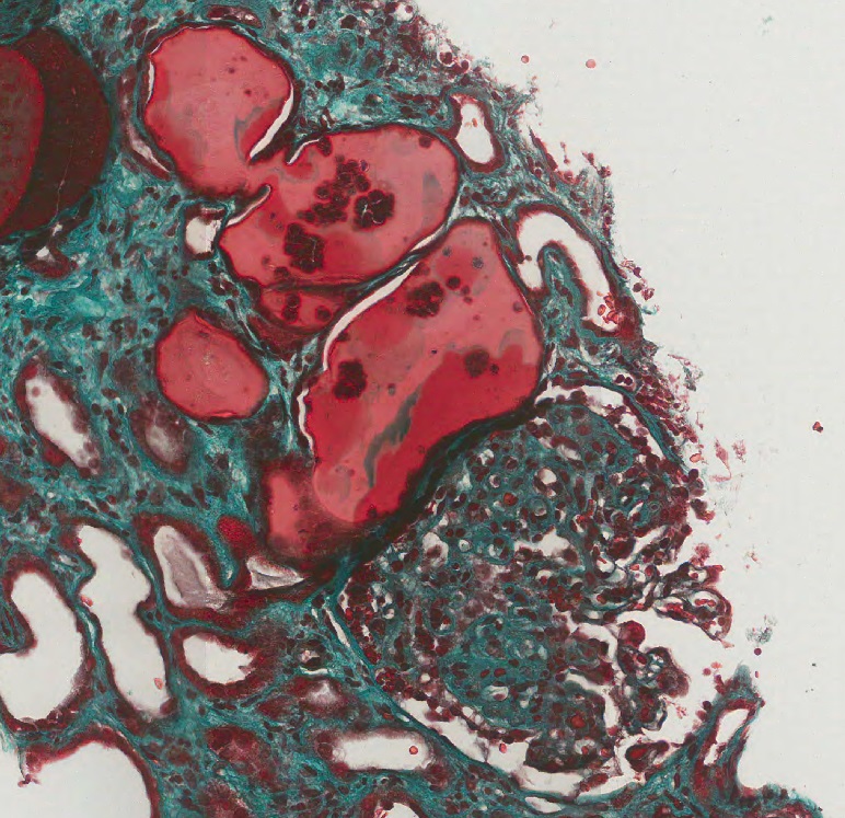 Tubular microcysts with sclerosed glomerulus