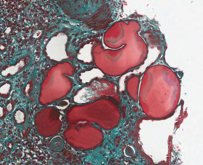 Tubular microcysts