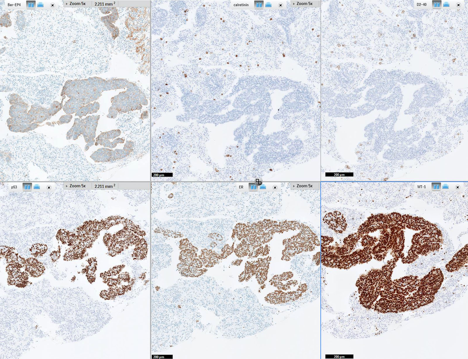 Fordított urothelialis papilloma p53 | Gél Papillor