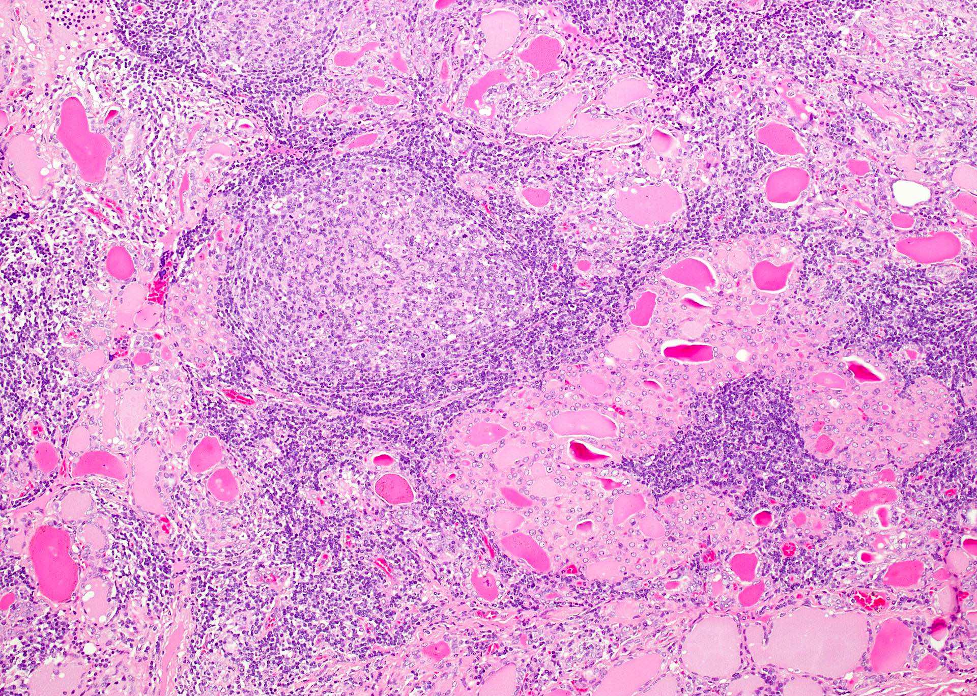 Hashimotos Thyroiditis Histology
