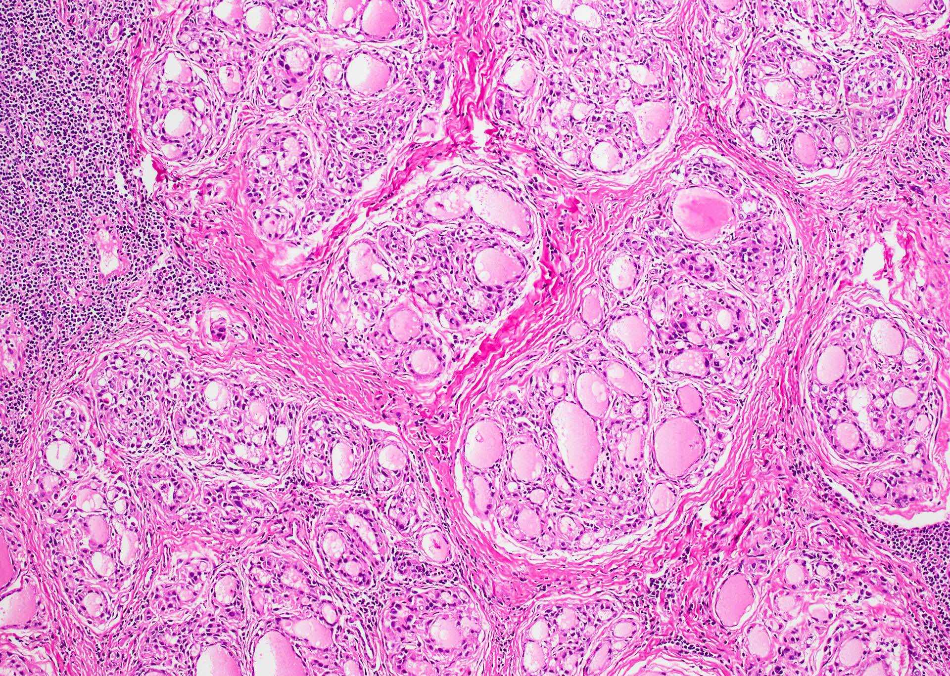 Hashimotos Thyroiditis Histology