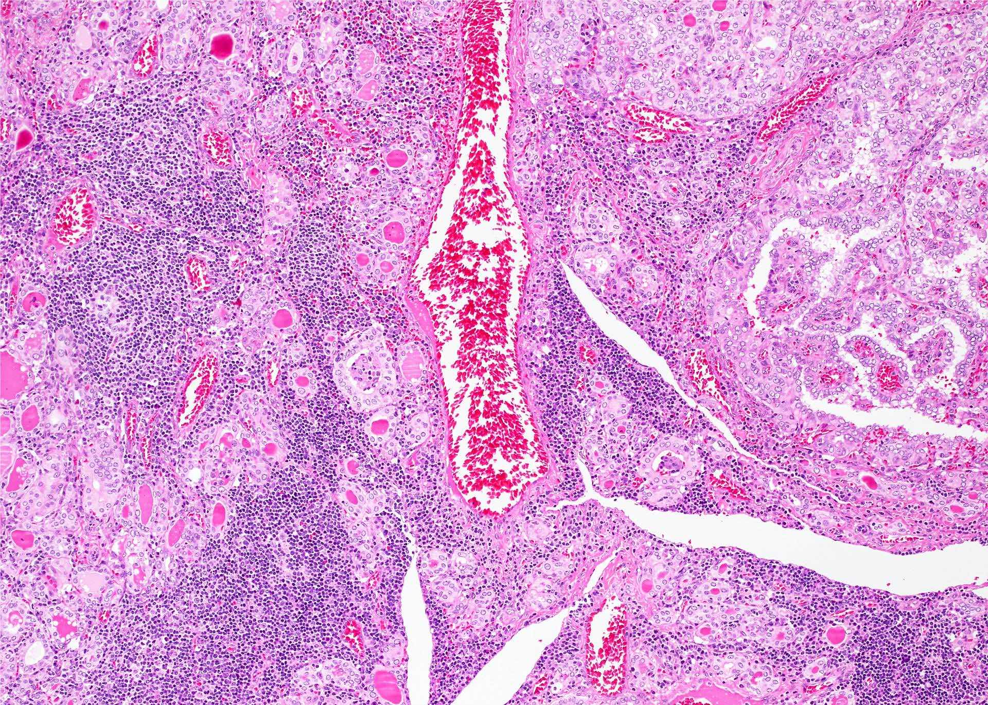 Hashimotos Thyroiditis Histology