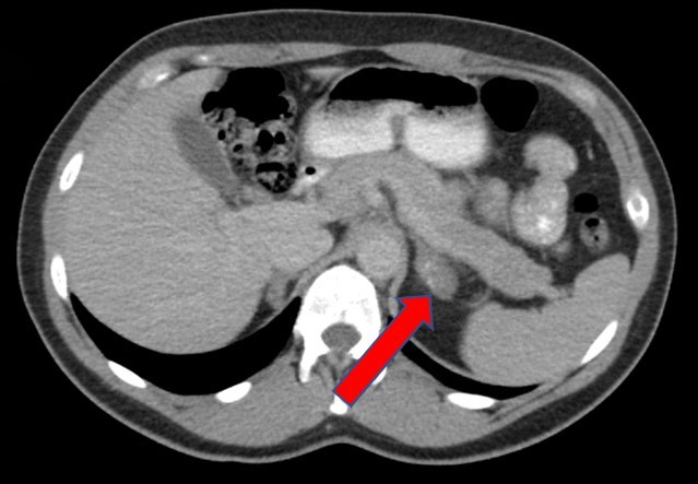 CT of left adrenal mass