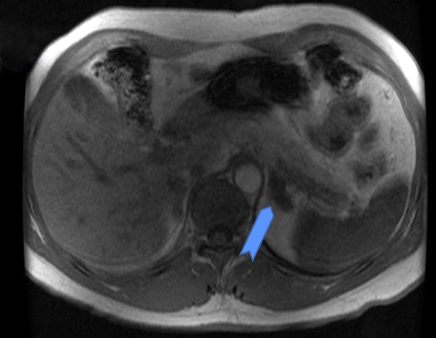 MRI of left adrenal mass