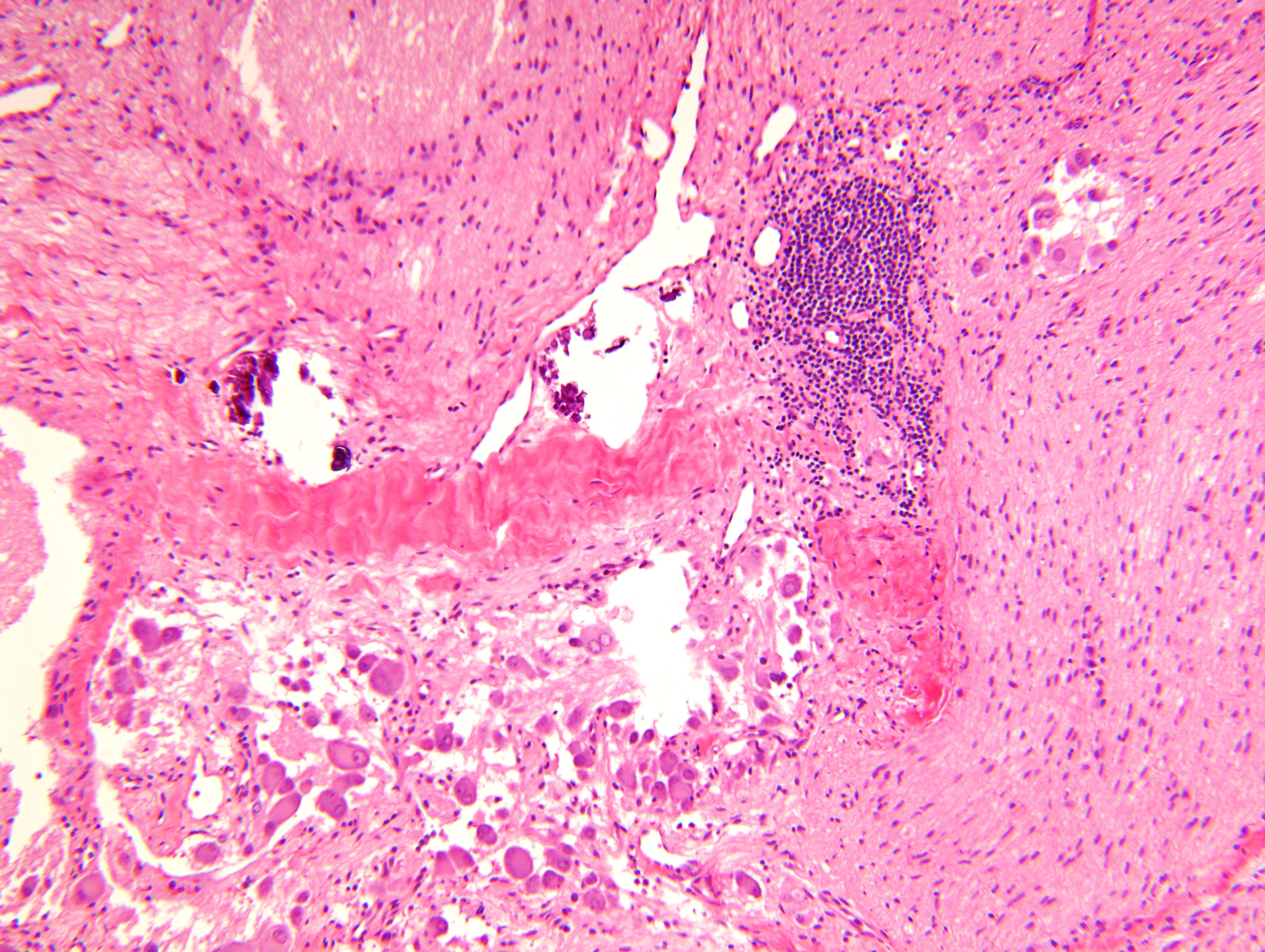 Aggregate of ganglion cells