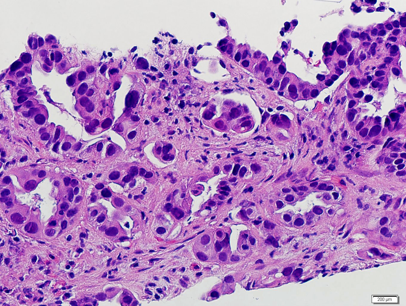 Adrenal metastasis from lung adenocarcinoma