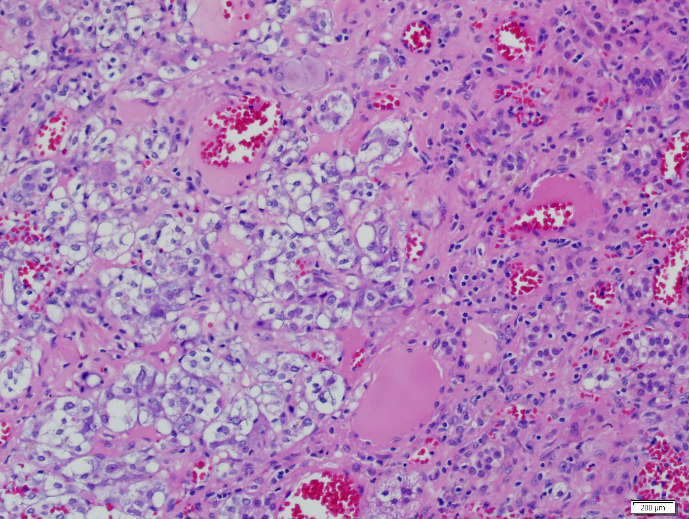 Adrenal metastasis from clear cell renal cell carcinoma