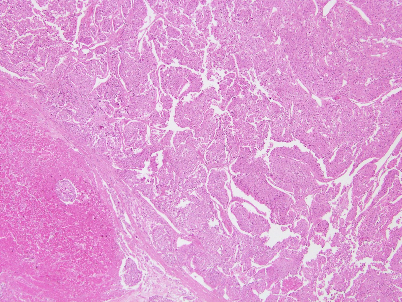 Oncocytic ACC with confluent necrosis