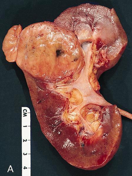 Tan and relatively homogeneous tumor