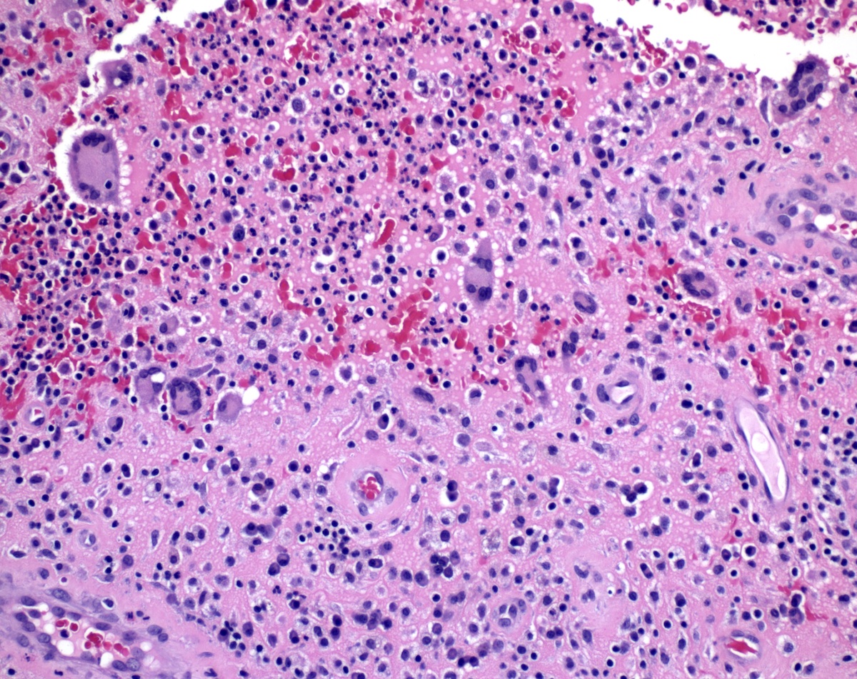 Giant cells, in association with granulation tissue