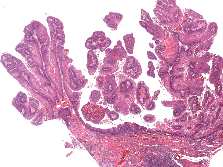 Well formed papillae with fibrovascular cores