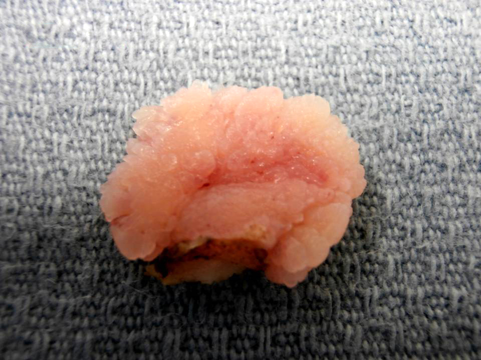 Vaginal condyloma