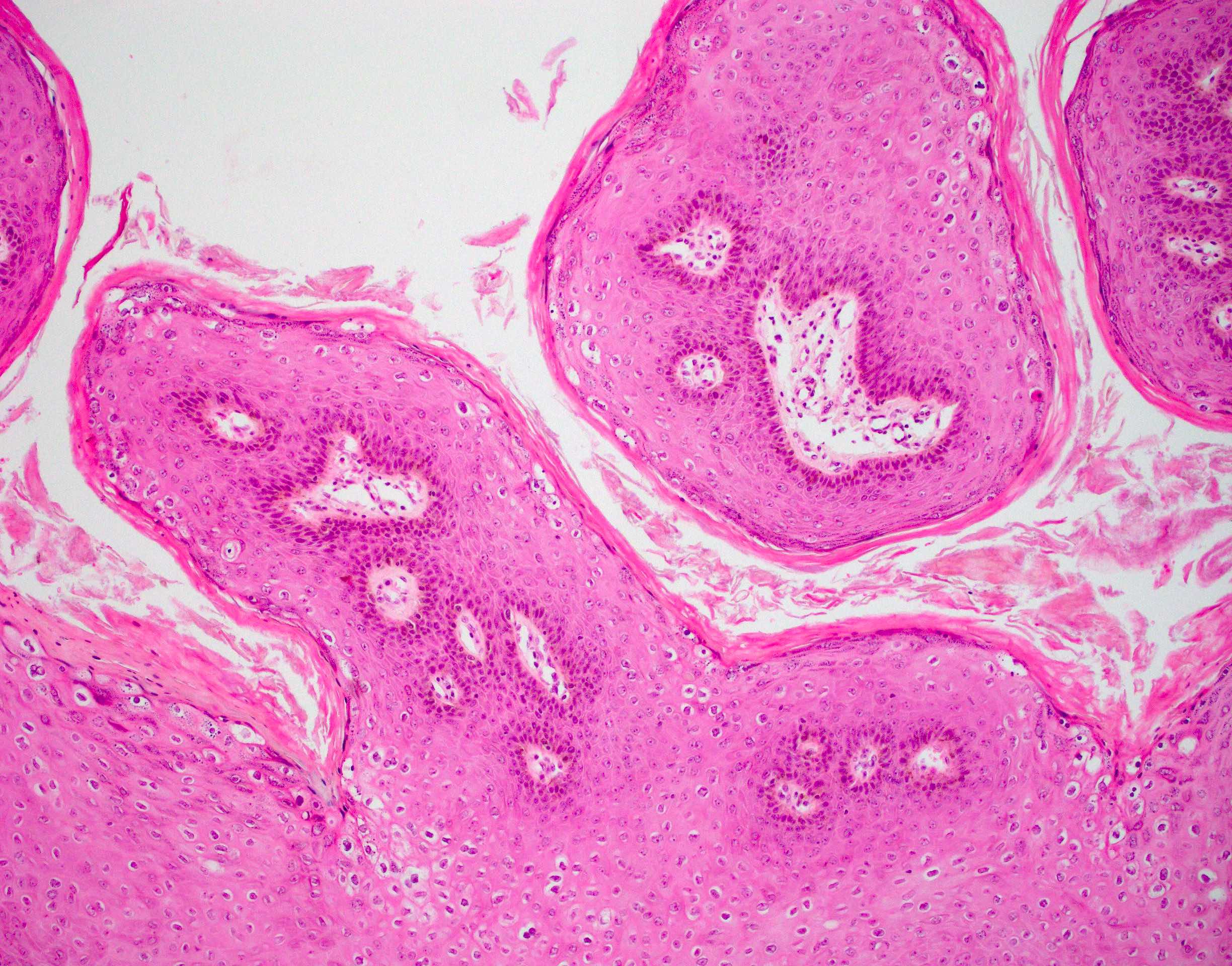 Papillary squamous proliferation, parakeratosis and koilocytosis