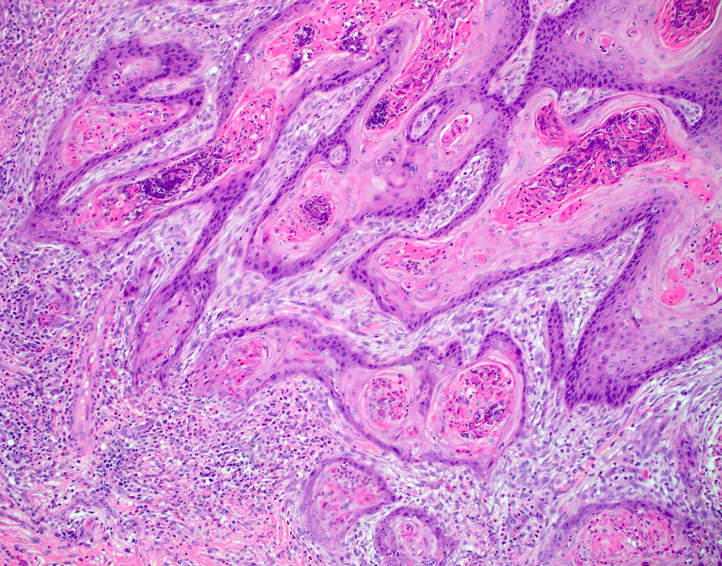 Invasive squamous cell carcinoma arising in condyloma