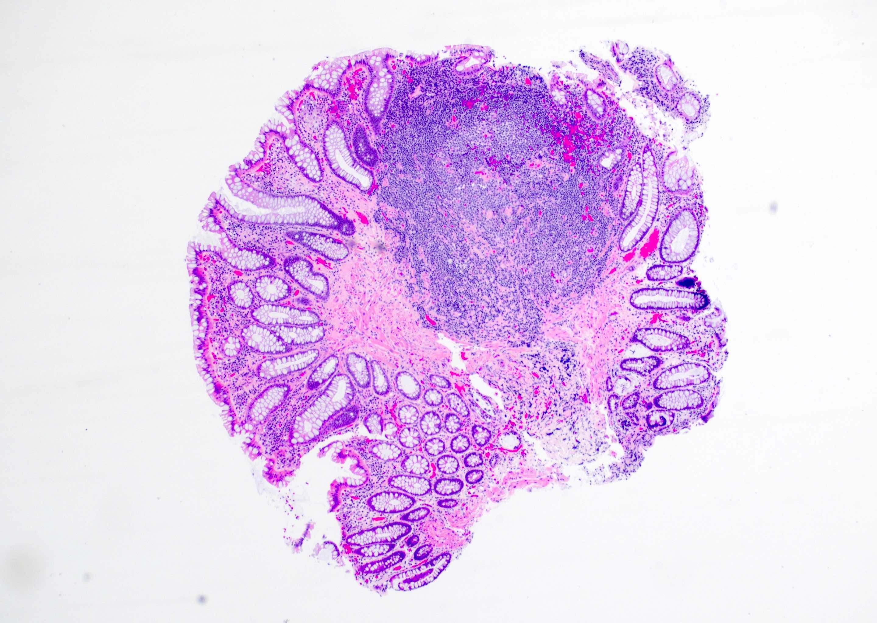 Lymphoid Aggregates: Harmless Or Harmful? Expert Opinion Inside - co3yenl