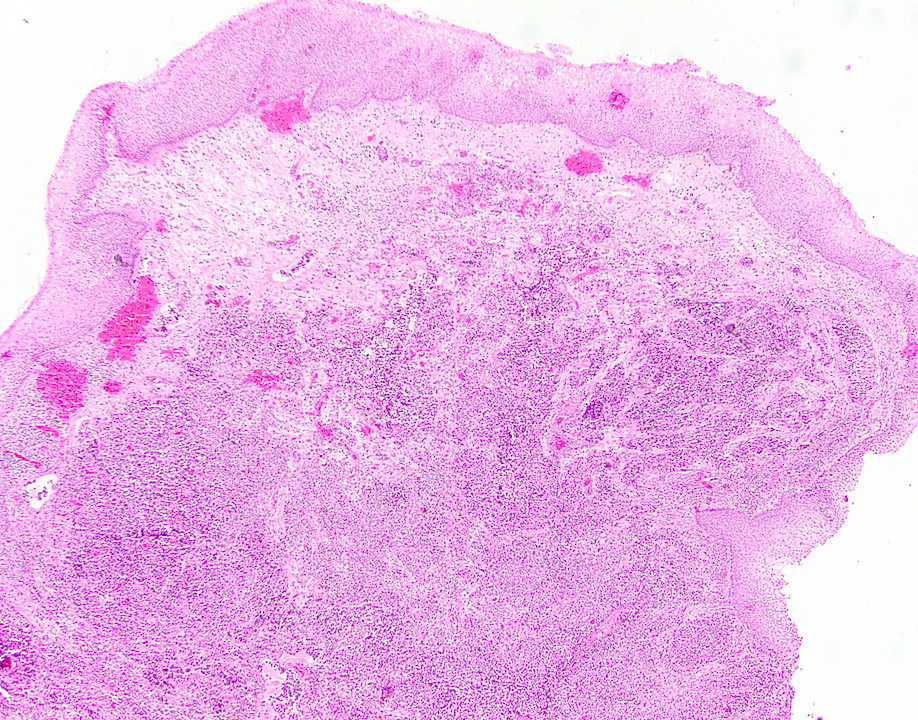Large cell carcinoma