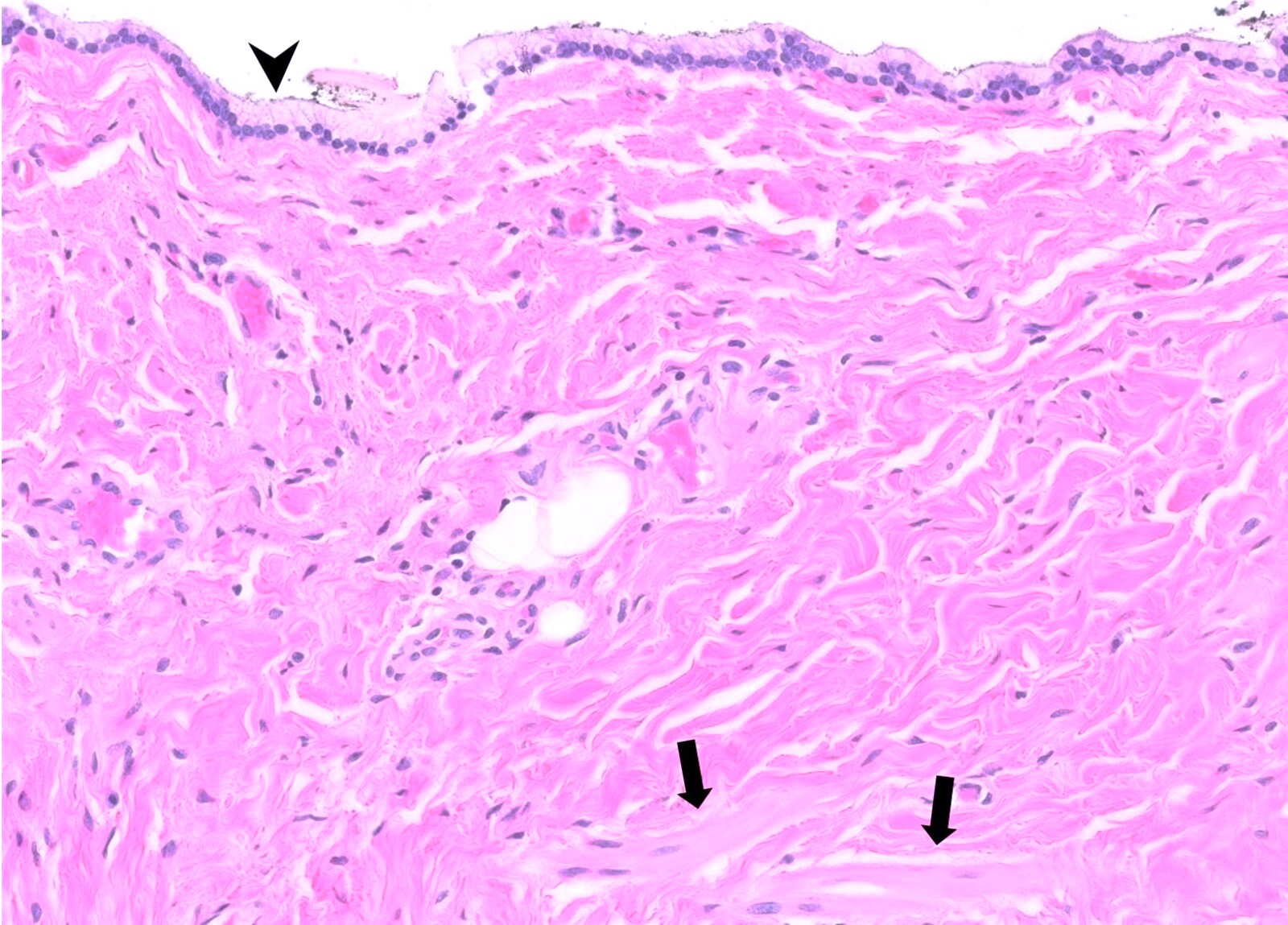 Mucinous columnar epithelium