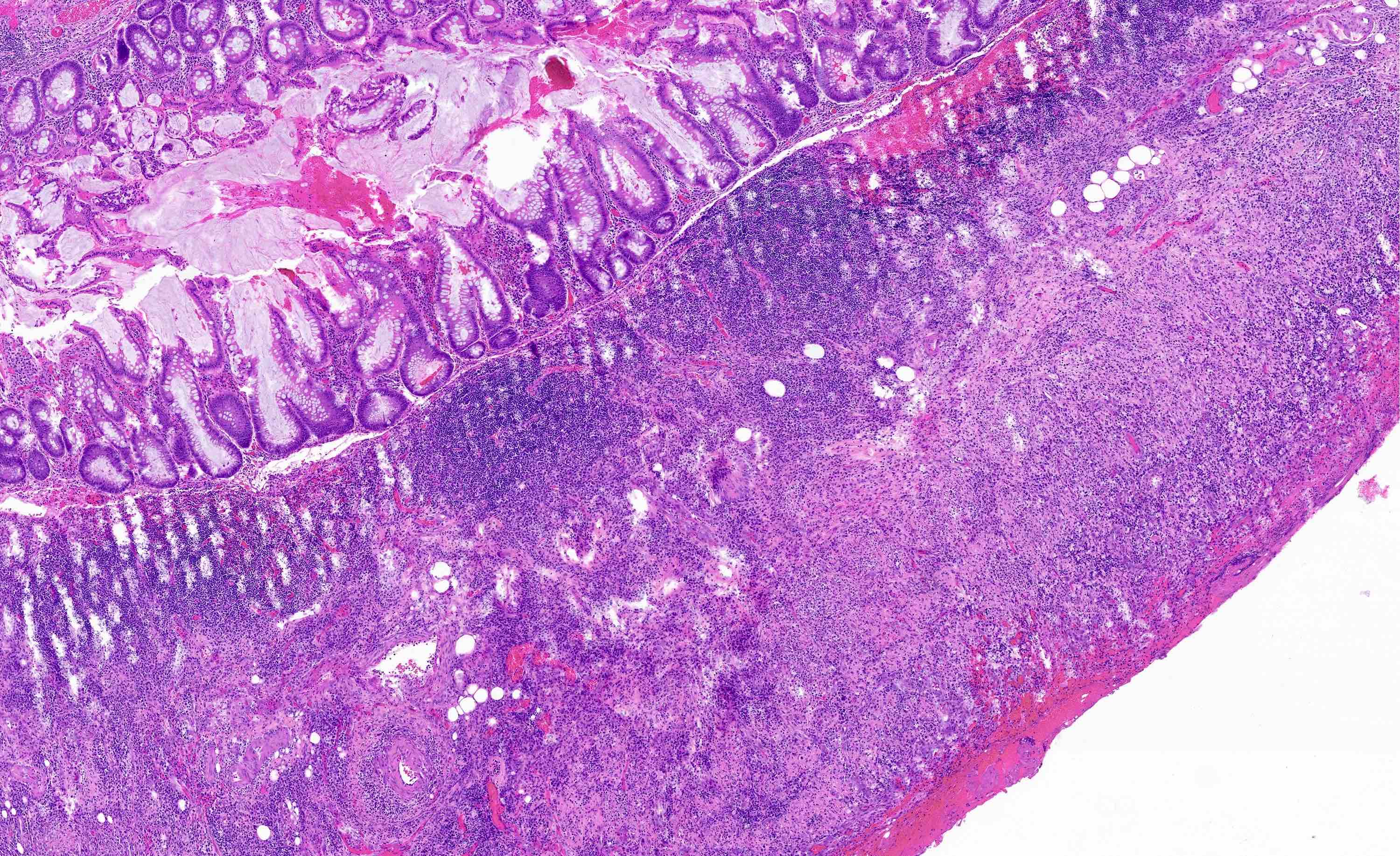 Transmural mixed inflammatory infiltrate