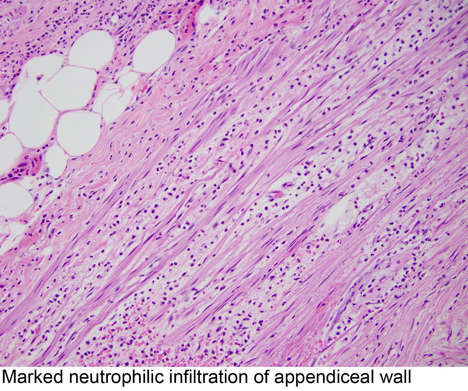 Pathology Of Acute Appendicitis Its Etiology Morphology Gross ...