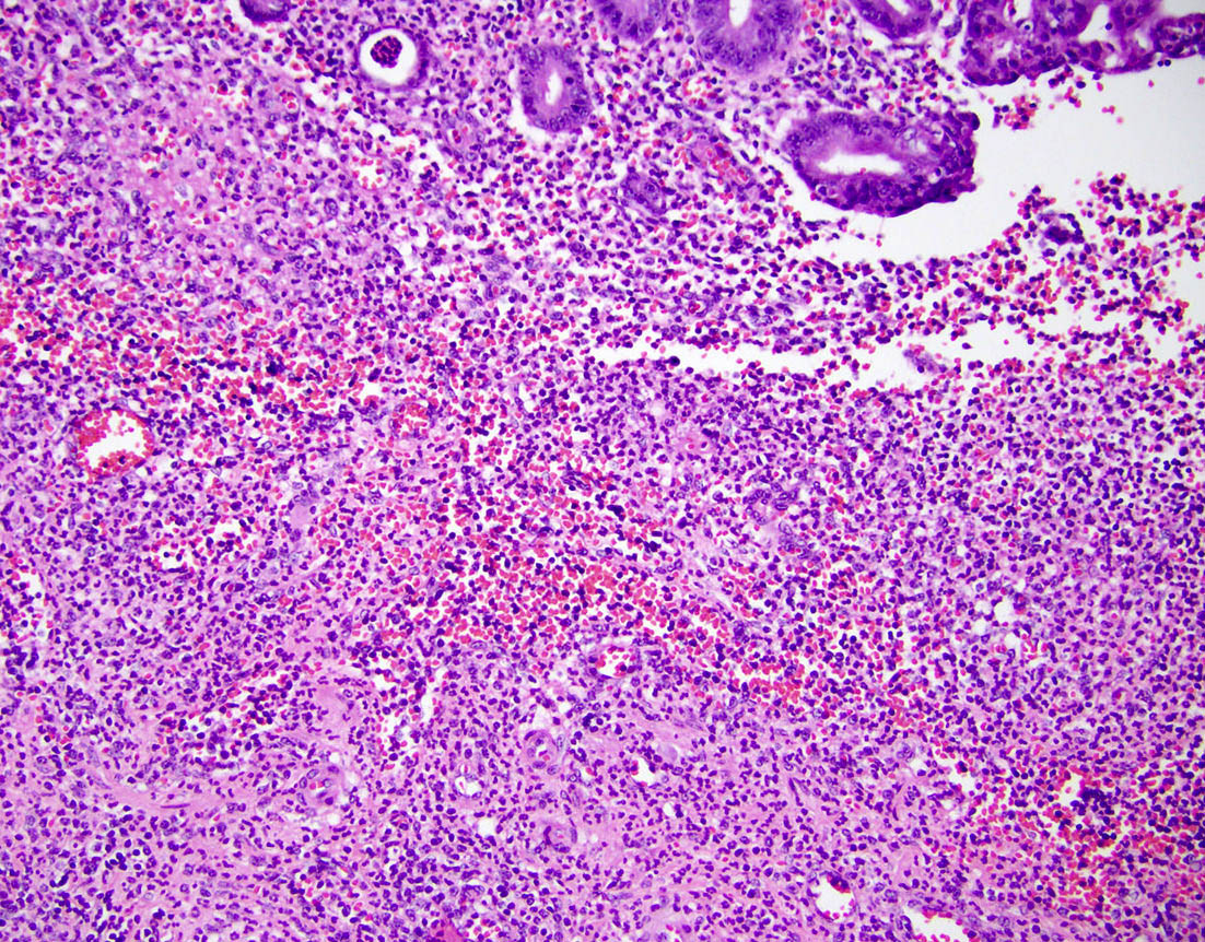 Marked neutrophilic infiltration