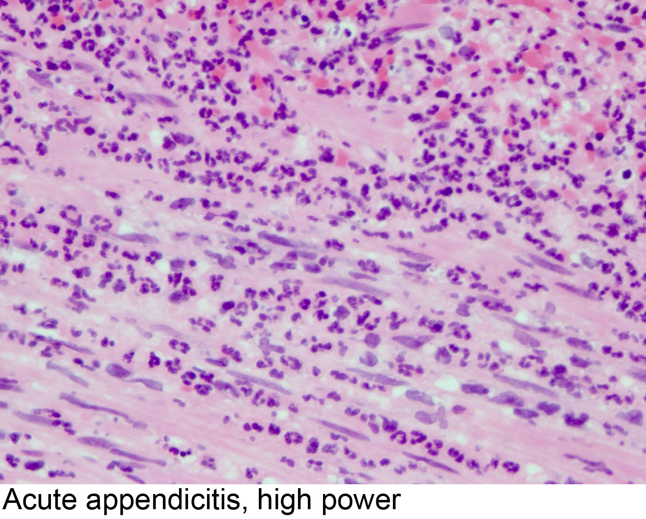 Pathology Outlines Acute Appendicitis