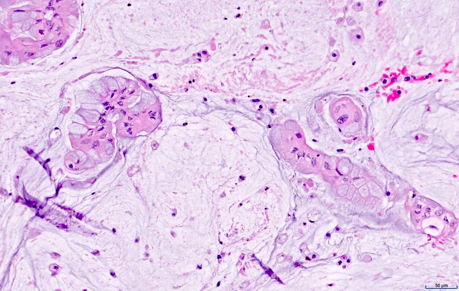 Tumor cells in mucin