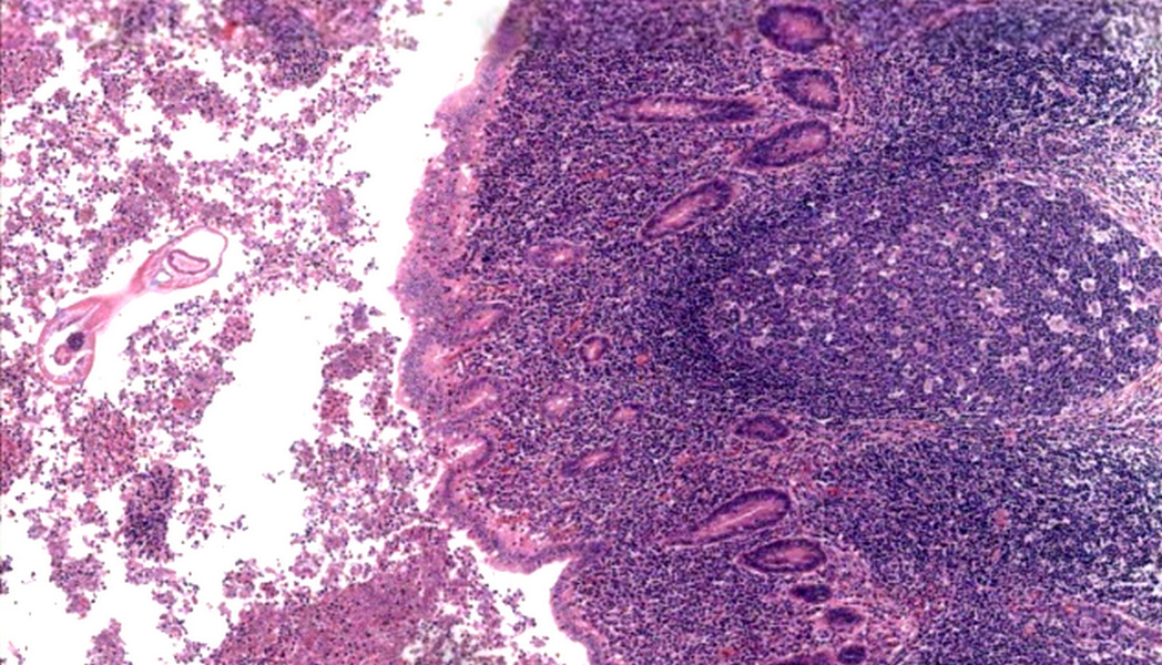 Papilloma urothelial pathology outlines Endometrial cancer pathology outlines