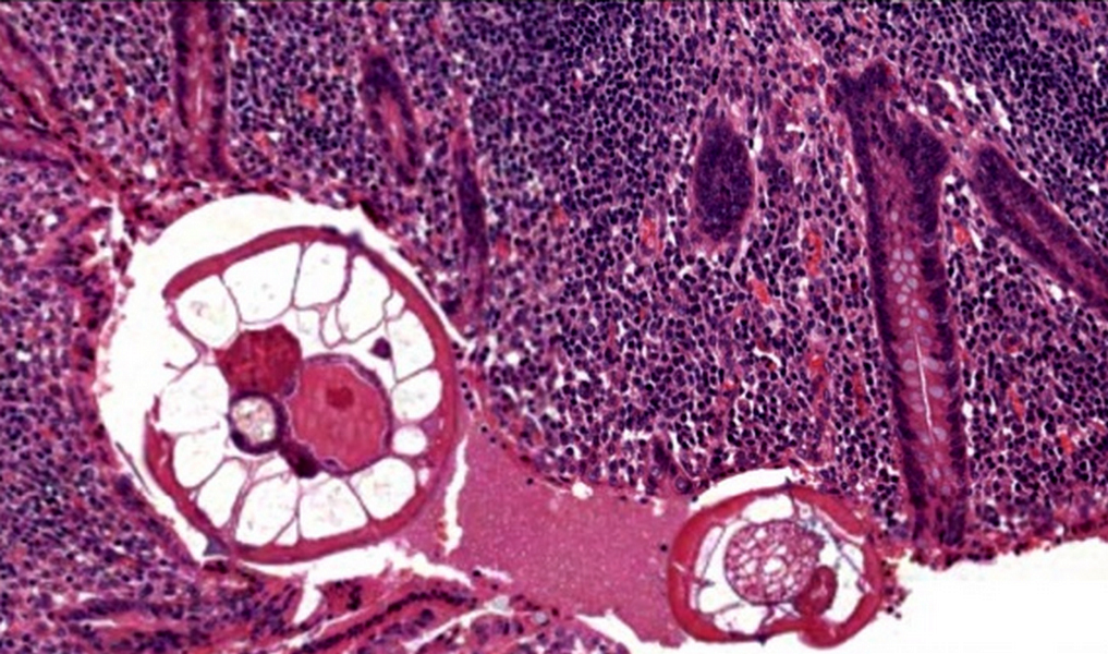 Enterobius vermicularis pathology