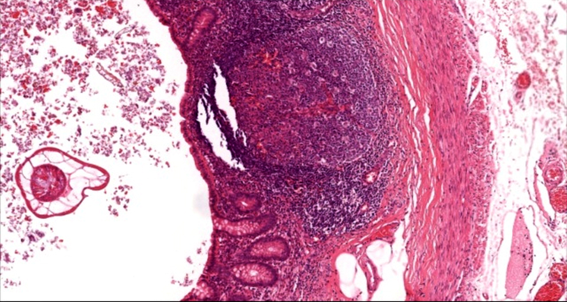 Appendix with luminal <i>Enterobius</i>