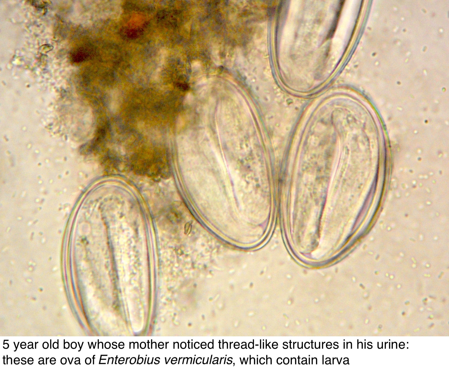 Enterobius vermicularis huevo