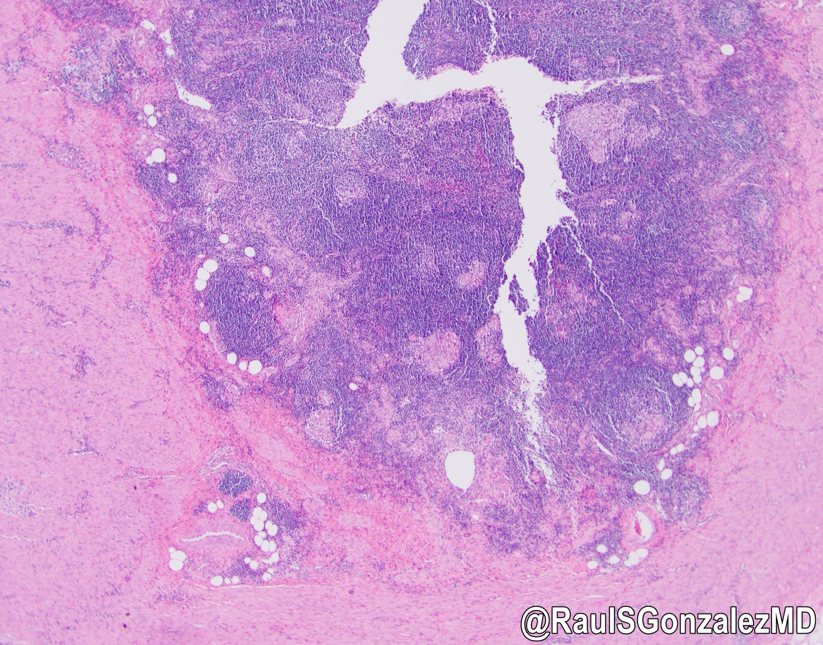 Primary anal melanoma