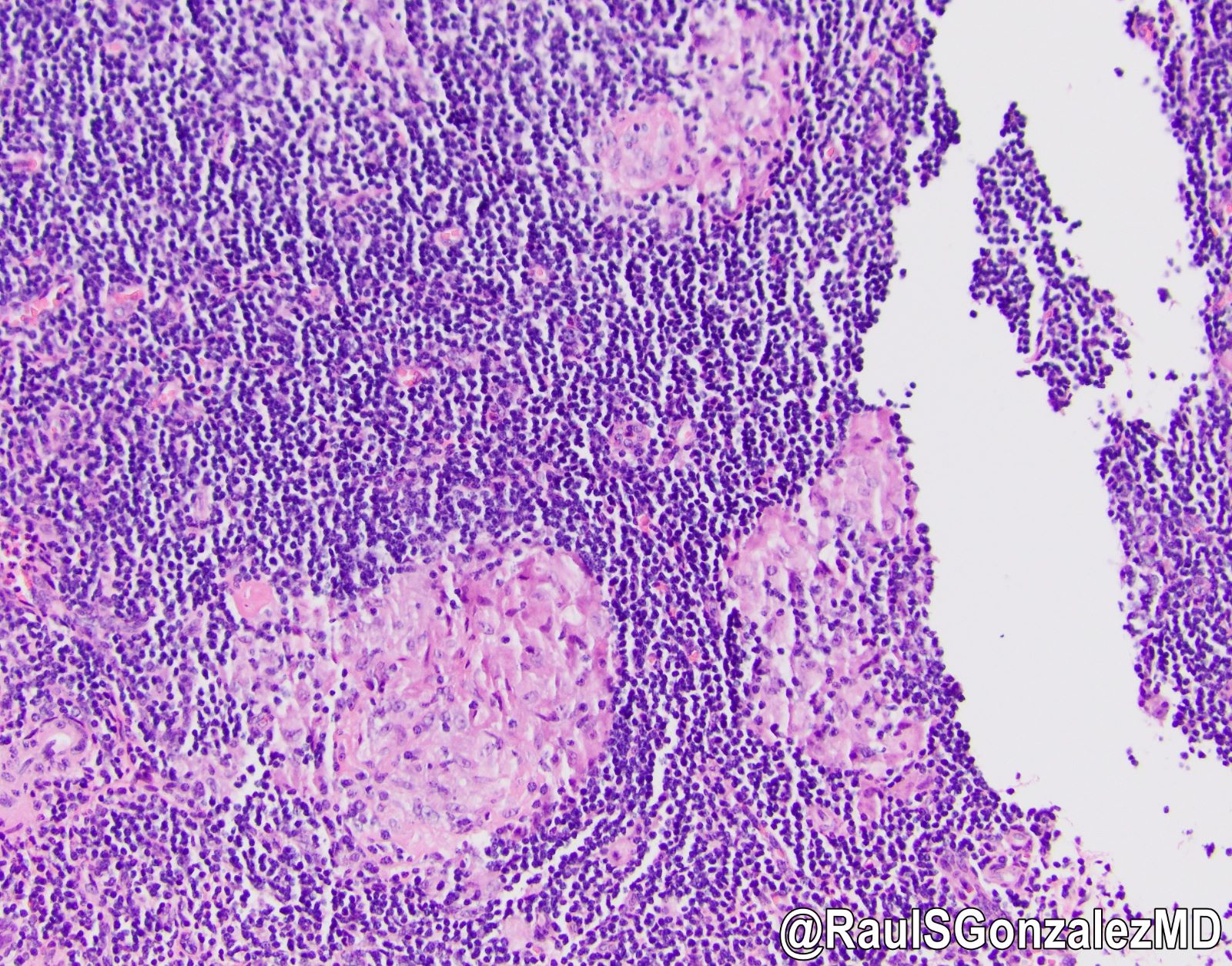 Primary anal melanoma