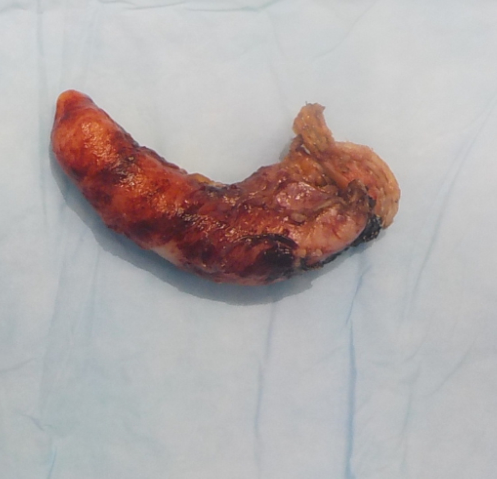 Mildly enlarged appendix