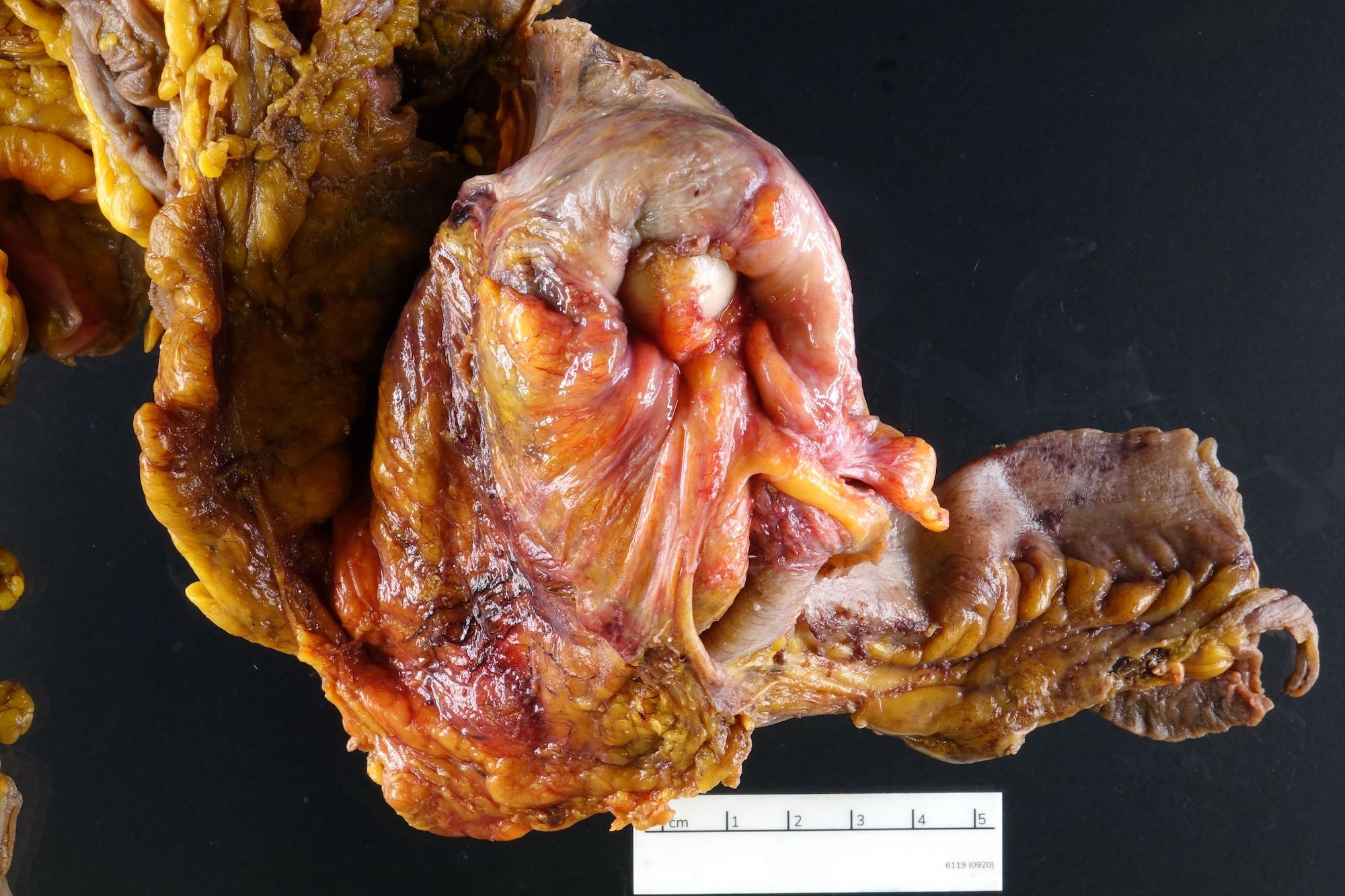 Serosal surface of inverted appendix