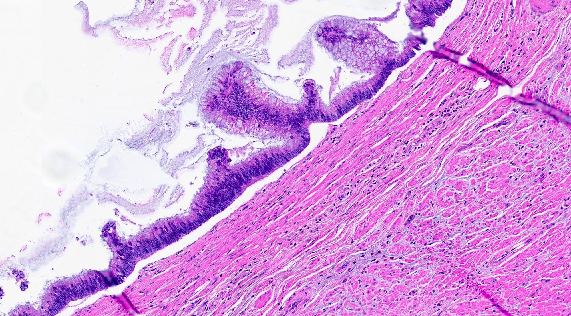 Appendiceal mucinous neoplasm