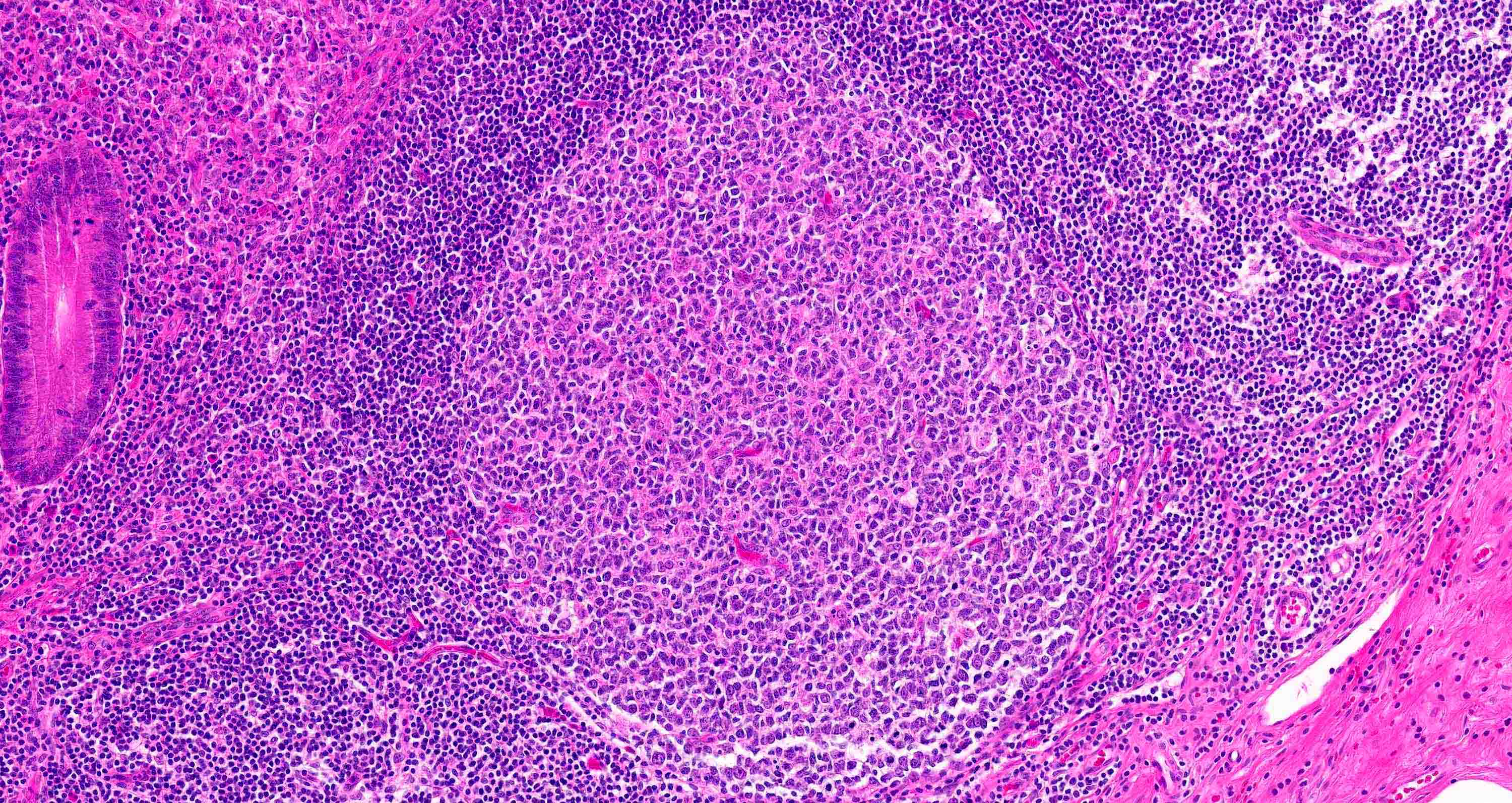 Lymphoid Aggregates:  Everything You Need To Know About Cancer Risk - hx9h1o7