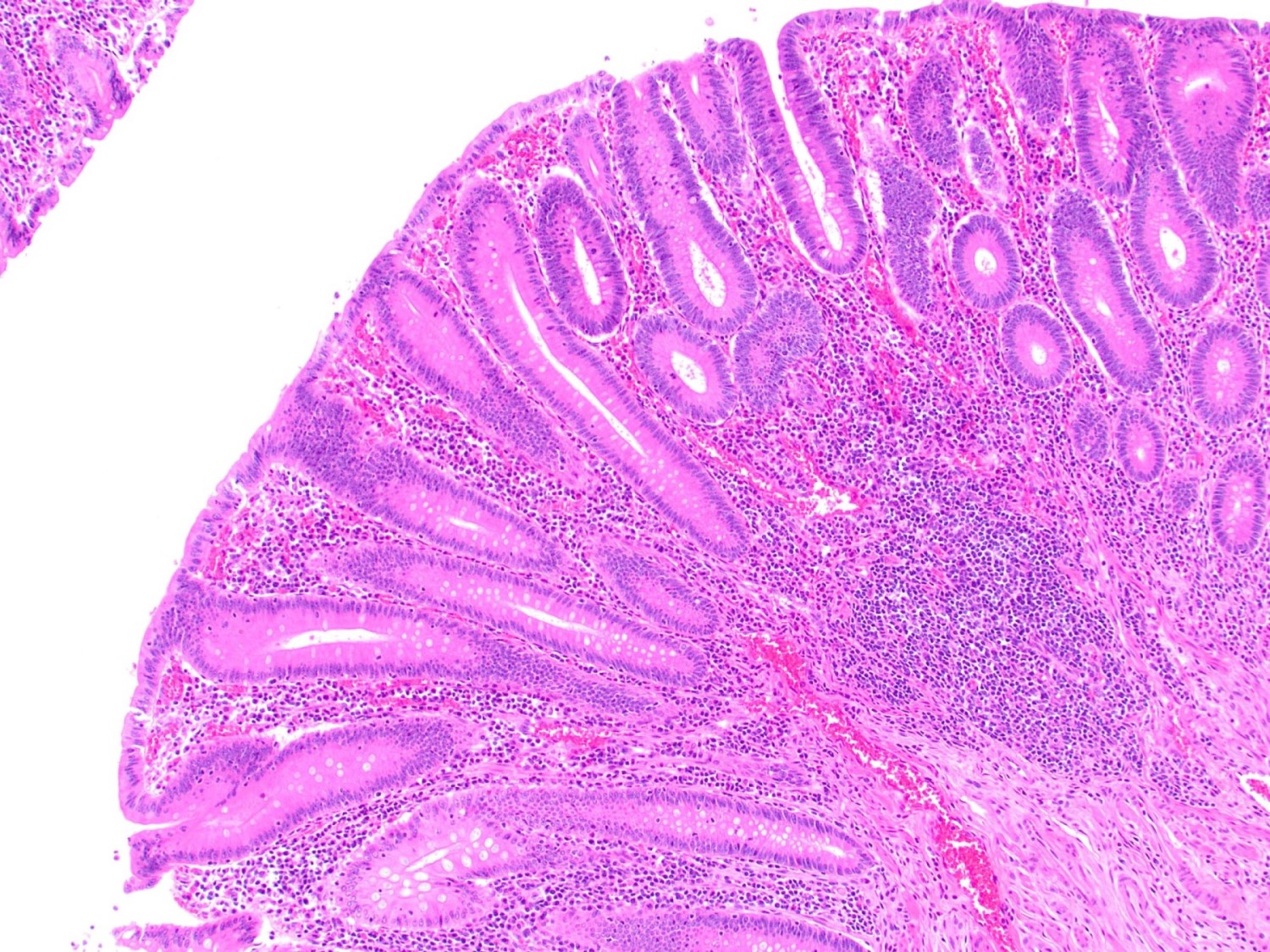Tubular glands with elongated, hyperchromatic nuclei and crowded glands