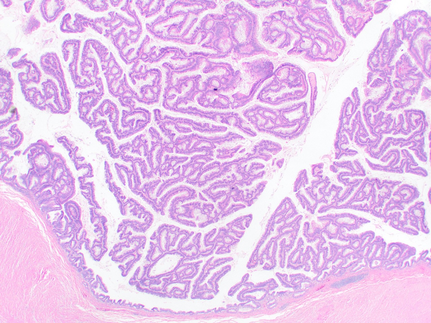 Crowded tubular and villous glands with elongated hyperchromatic nuclei