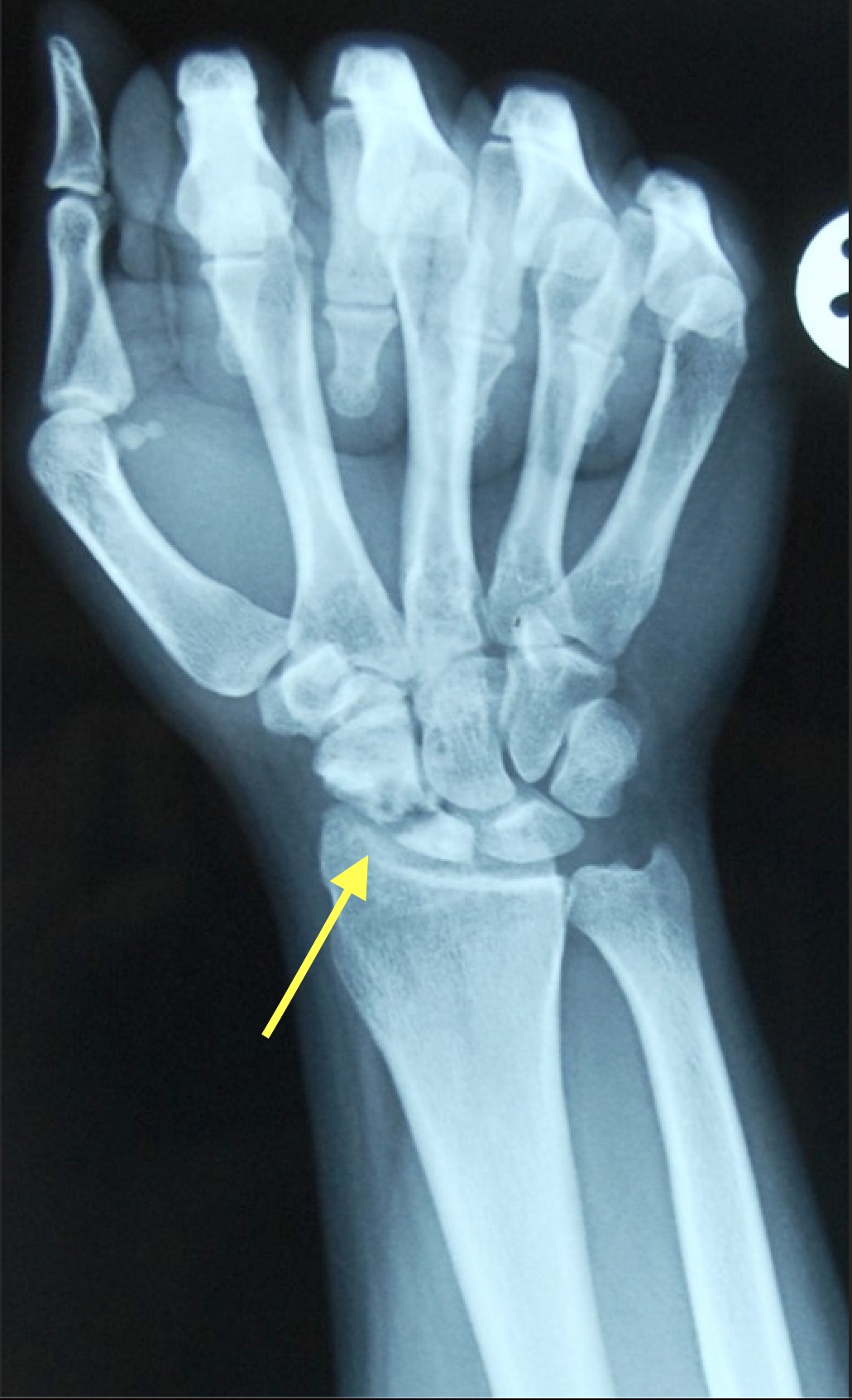 Postmortem radiography scaphoid fracture